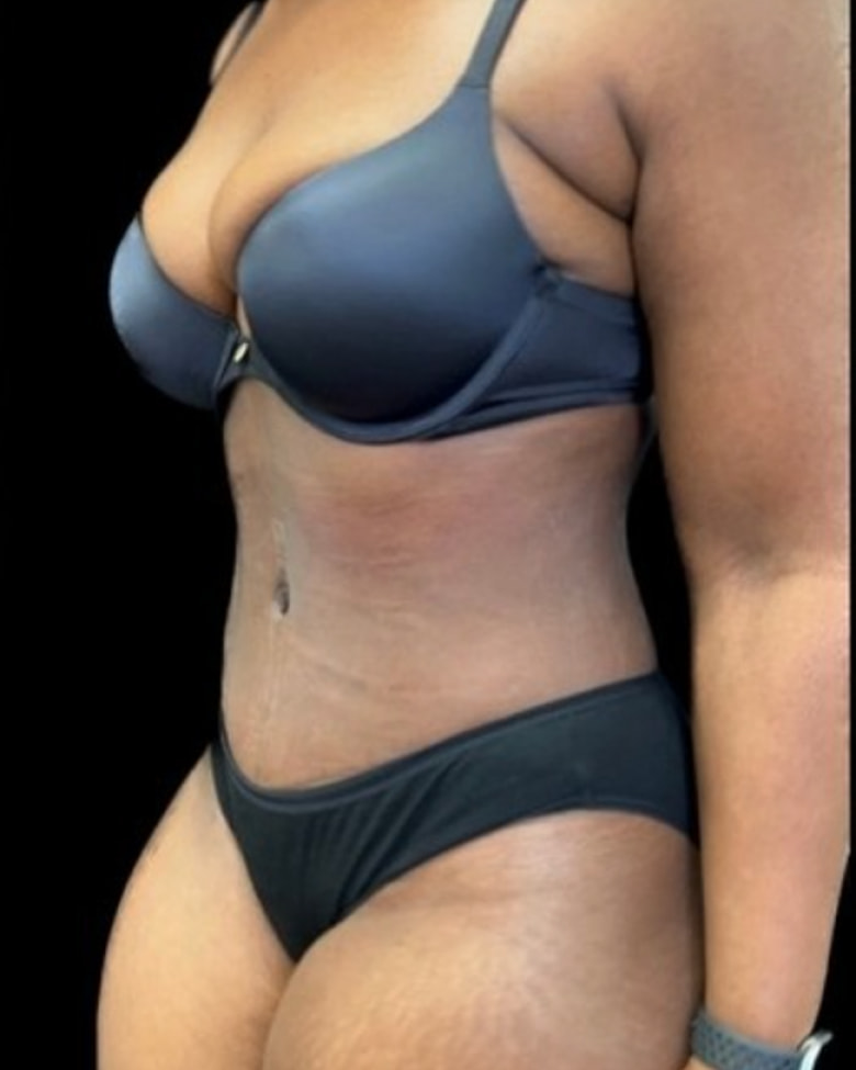 Silhouette après une abdominoplastie