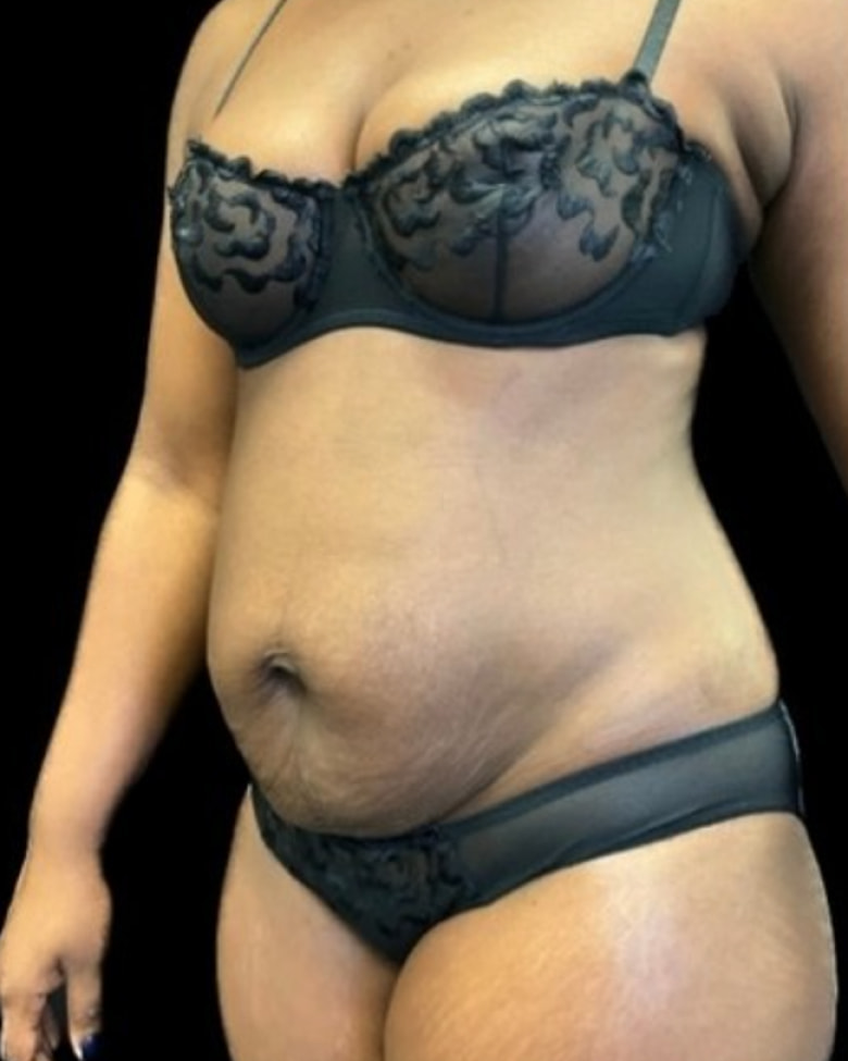 Silhouette avant une abdominoplastie