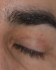 Paupière supérieure après une blépharoplastie