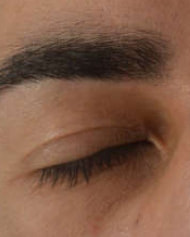 Paupière supérieure avant une blépharoplastie