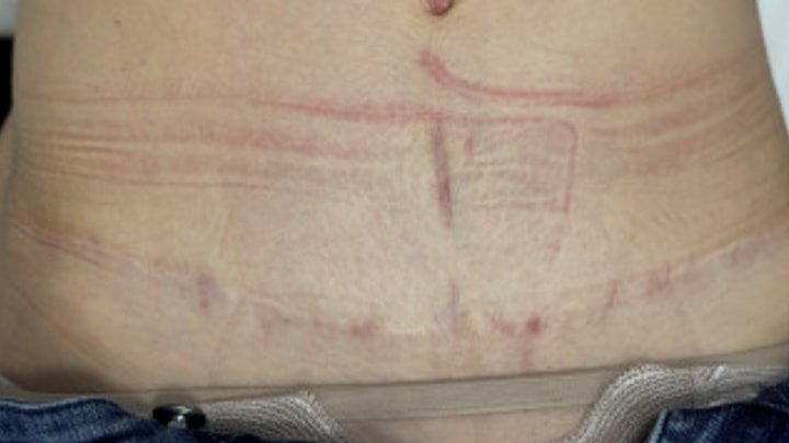 Cicatrice abdominale à une étape avancée du suivi clinique