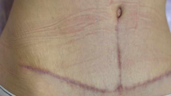 Cicatrice abdominale au début du suivi clinique