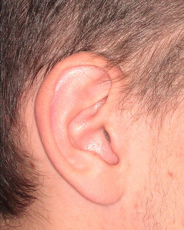 Oreille cinq ans après une otoplastie