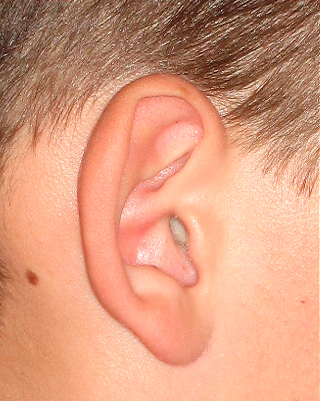 Oreille avant une otoplastie