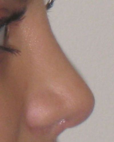 Profil après une rhinoplastie