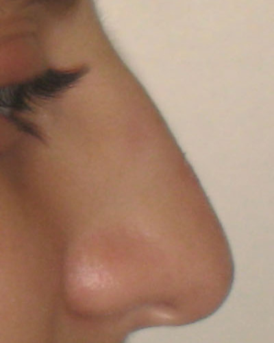 Profil avant une rhinoplastie